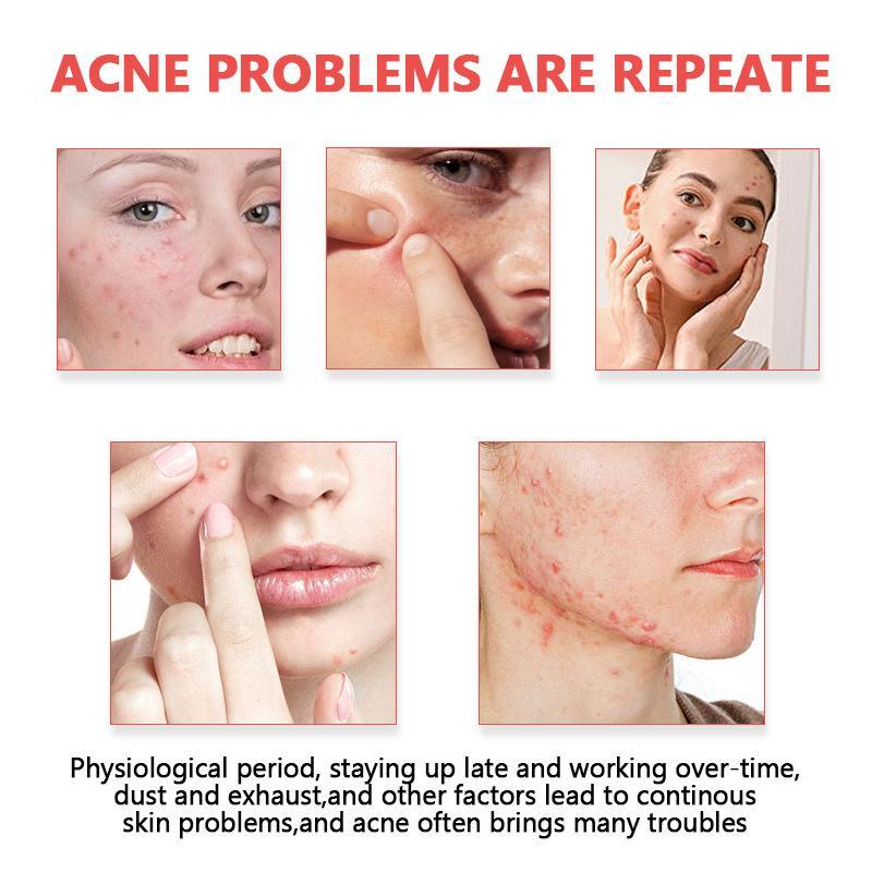 Parches para el Acné, Cubre Gr - Skincare Oil Control reseña y precio